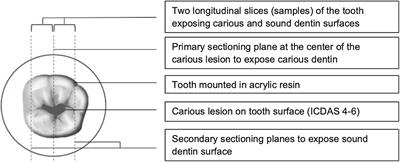 In-vitro Assessment of Silver Diamine Fluoride Effect on Natural Carious Dentin Microhardness